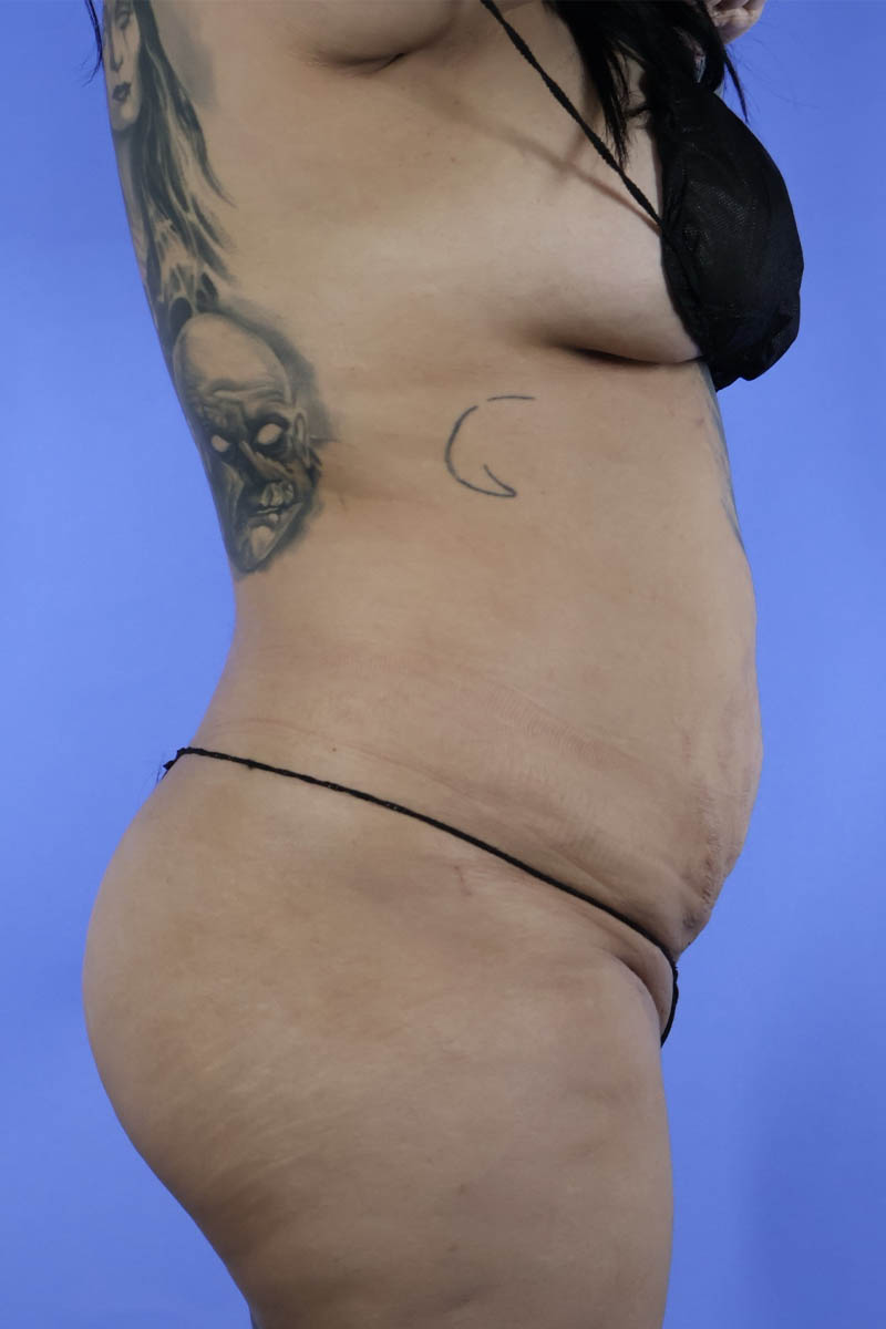 Tummy Tuck real patient case photo Tummy Tuck real patient case photo