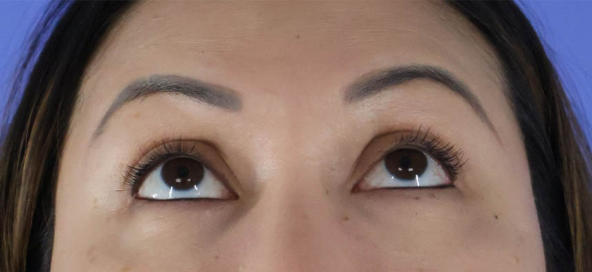 Eyelid Surgery real patient case photo Eyelid Surgery real patient case photo
