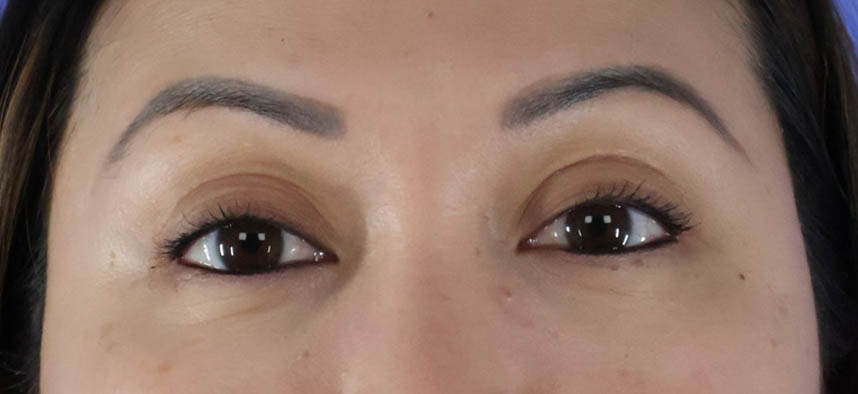 Eyelid Surgery real patient case photo Eyelid Surgery real patient case photo