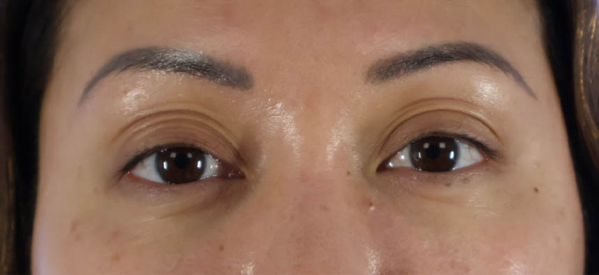 Eyelid Surgery real patient case photo Eyelid Surgery real patient case photo