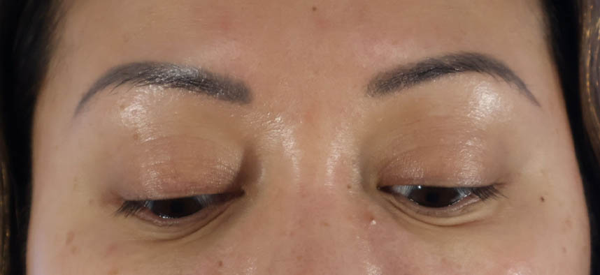 Eyelid Surgery real patient case photo Eyelid Surgery real patient case photo
