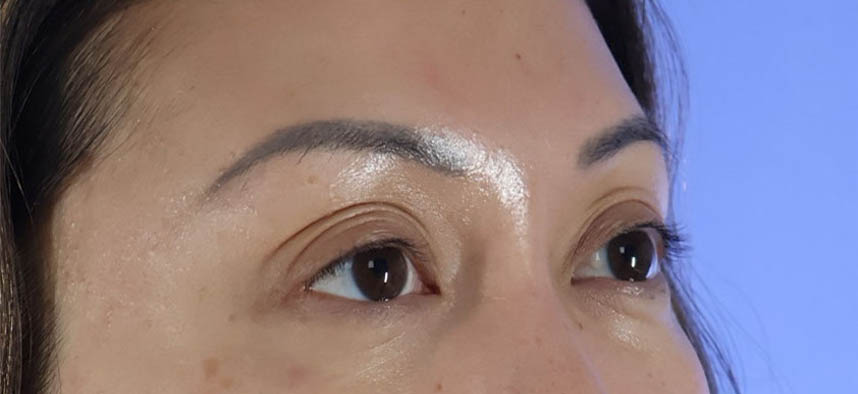 Eyelid Surgery real patient case photo Eyelid Surgery real patient case photo