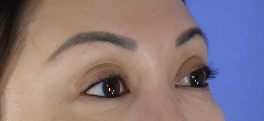 Eyelid Surgery real patient case photo Eyelid Surgery real patient case photo