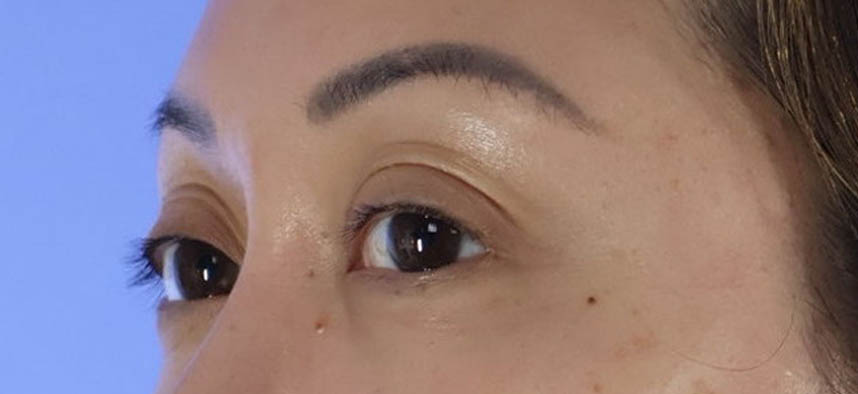 Eyelid Surgery real patient case photo Eyelid Surgery real patient case photo