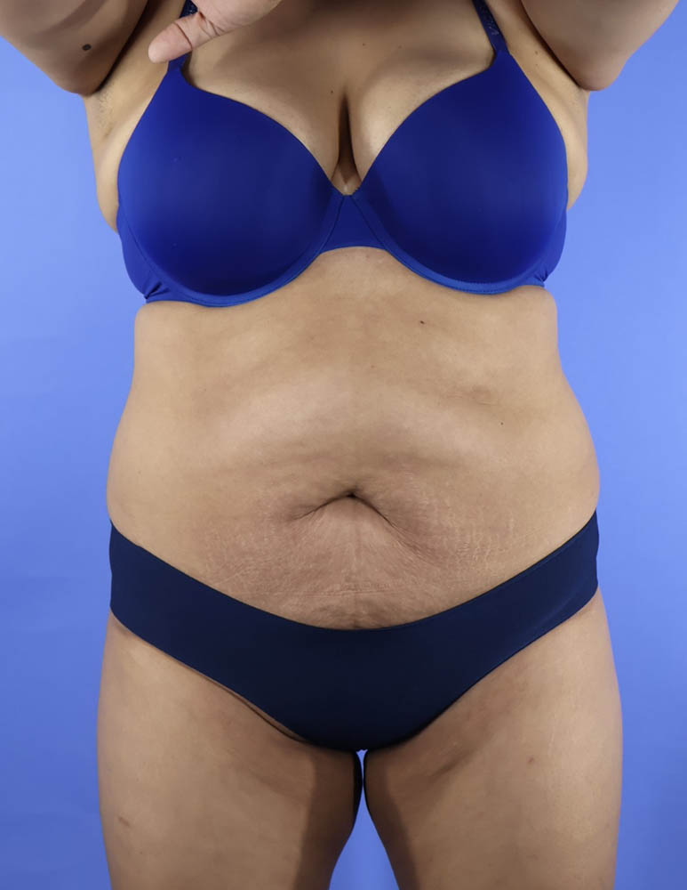 Liposuction real patient case photo