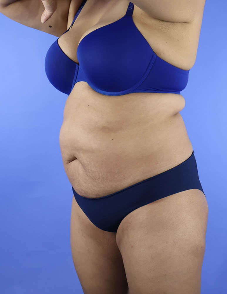 Liposuction real patient case photo