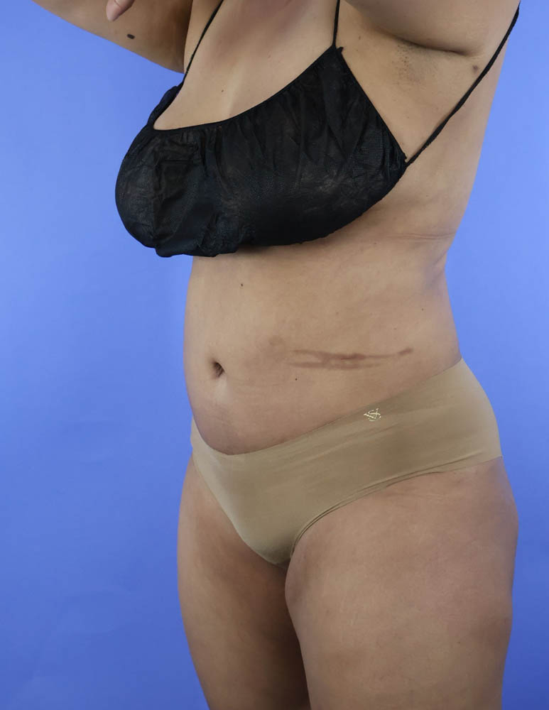 Liposuction real patient case photo
