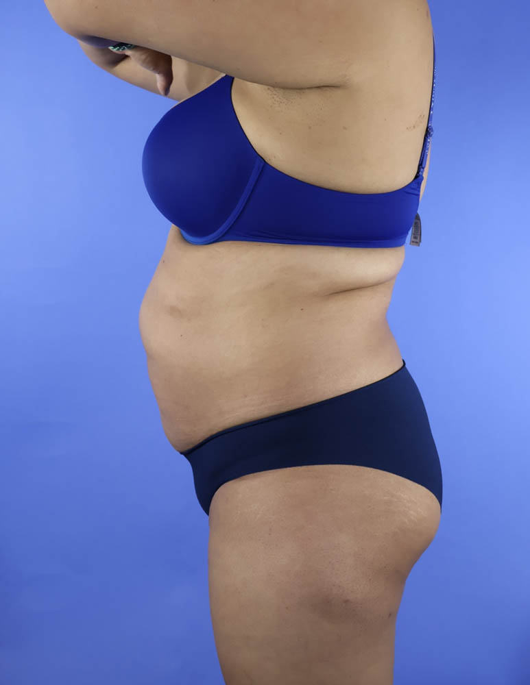 Liposuction real patient case photo