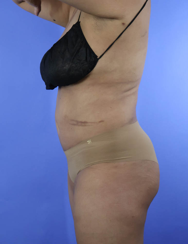 Liposuction real patient case photo