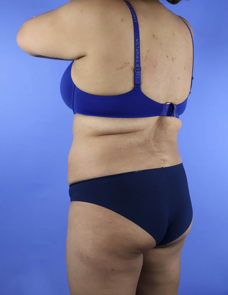 Liposuction real patient case photo
