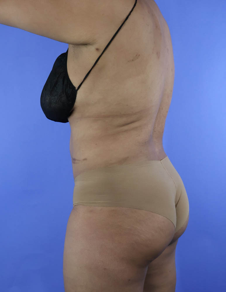 Liposuction real patient case photo