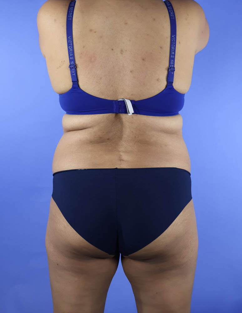 Liposuction real patient case photo