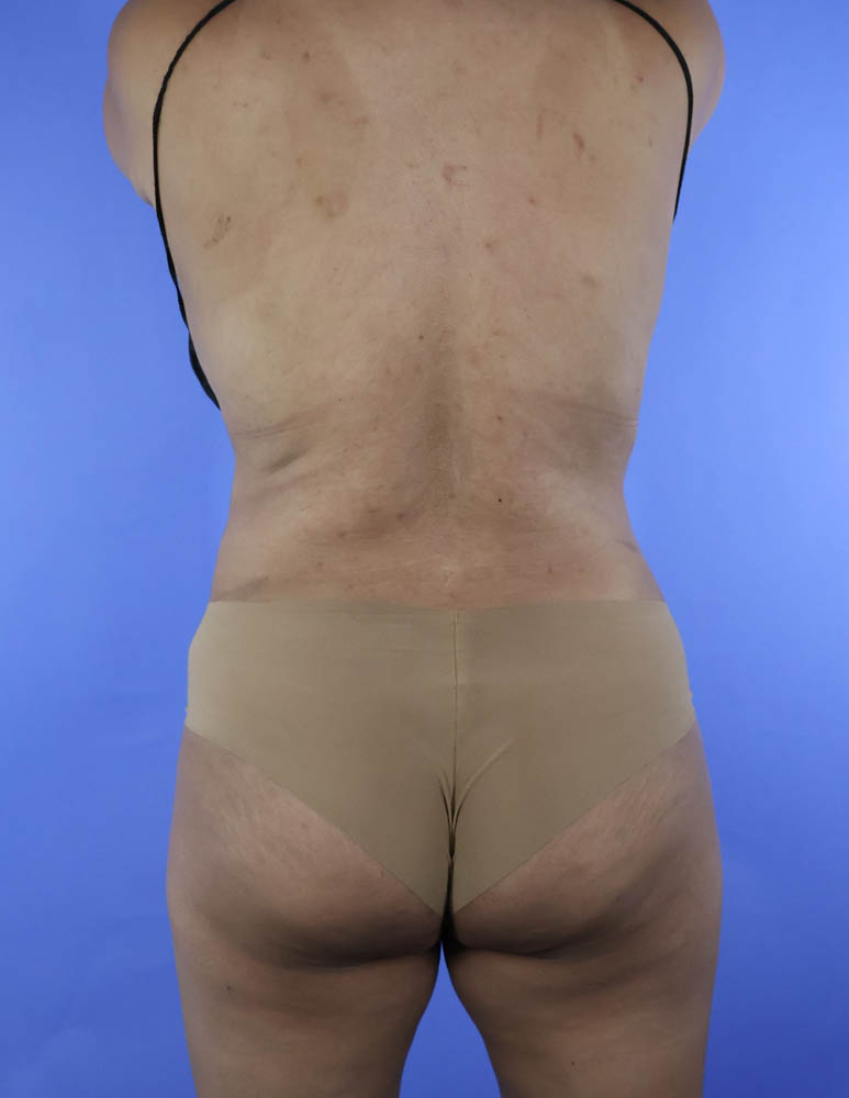 Liposuction real patient case photo