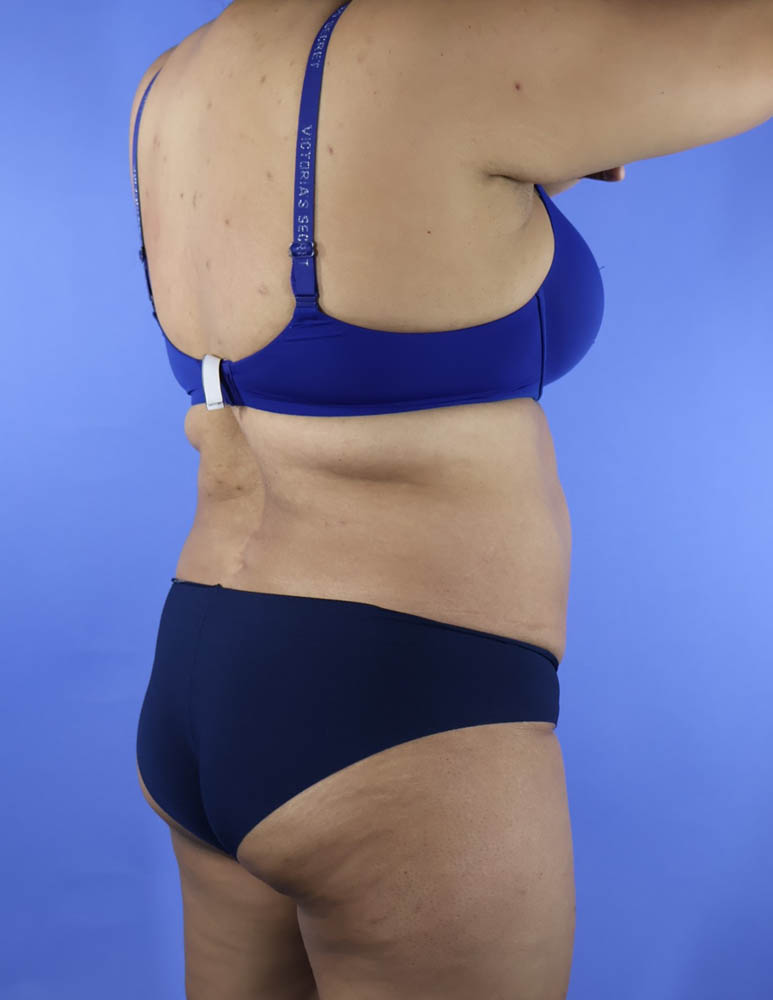 Liposuction real patient case photo