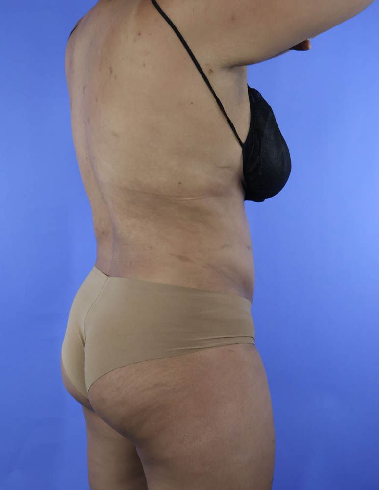 Liposuction real patient case photo