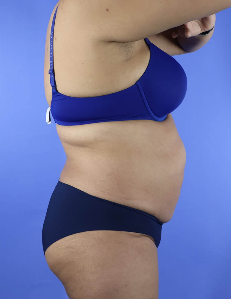 Liposuction real patient case photo