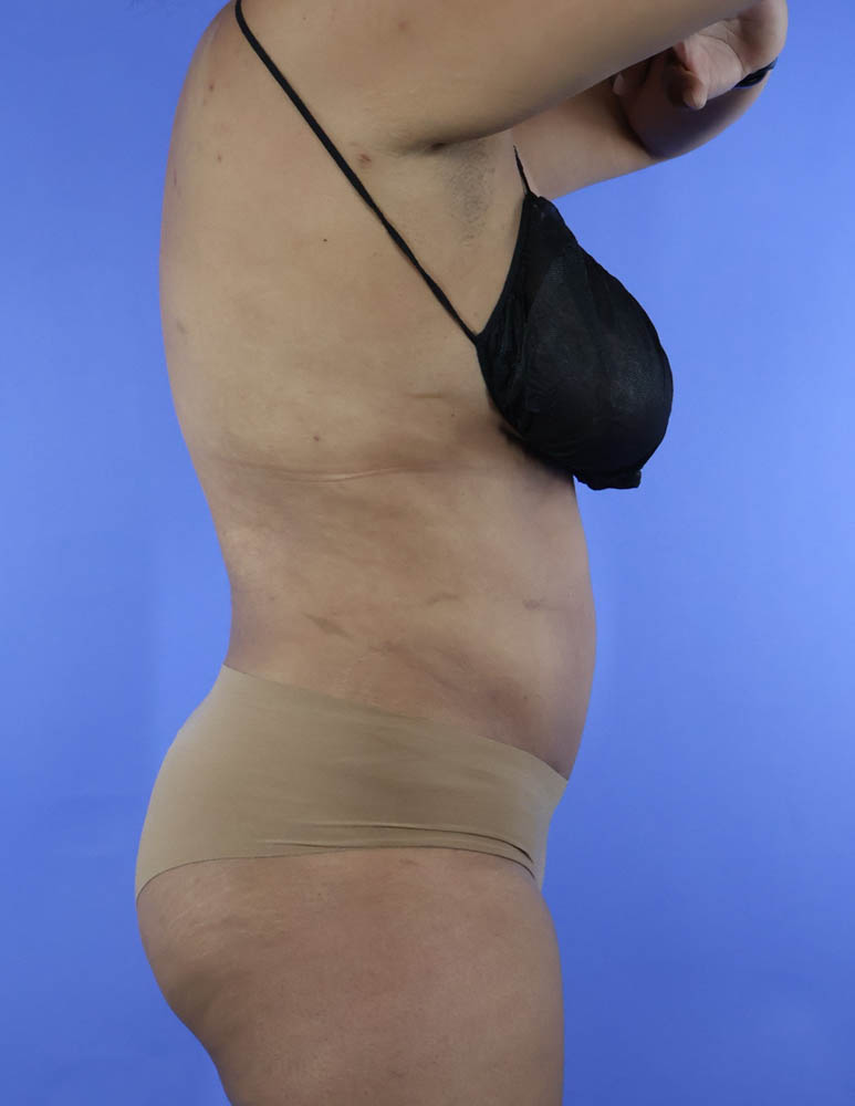 Liposuction real patient case photo