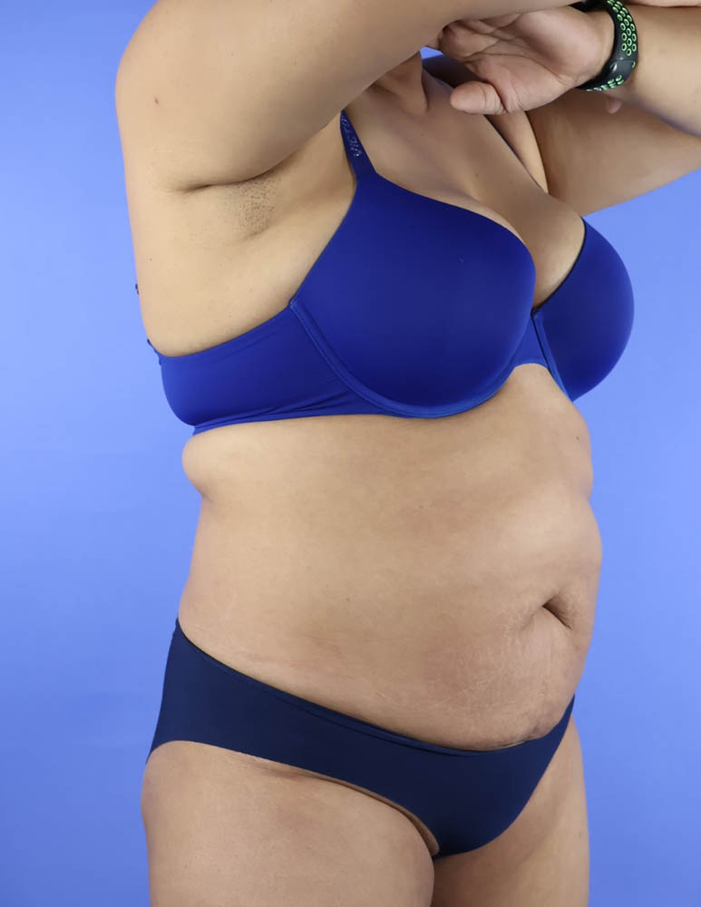 Liposuction real patient case photo