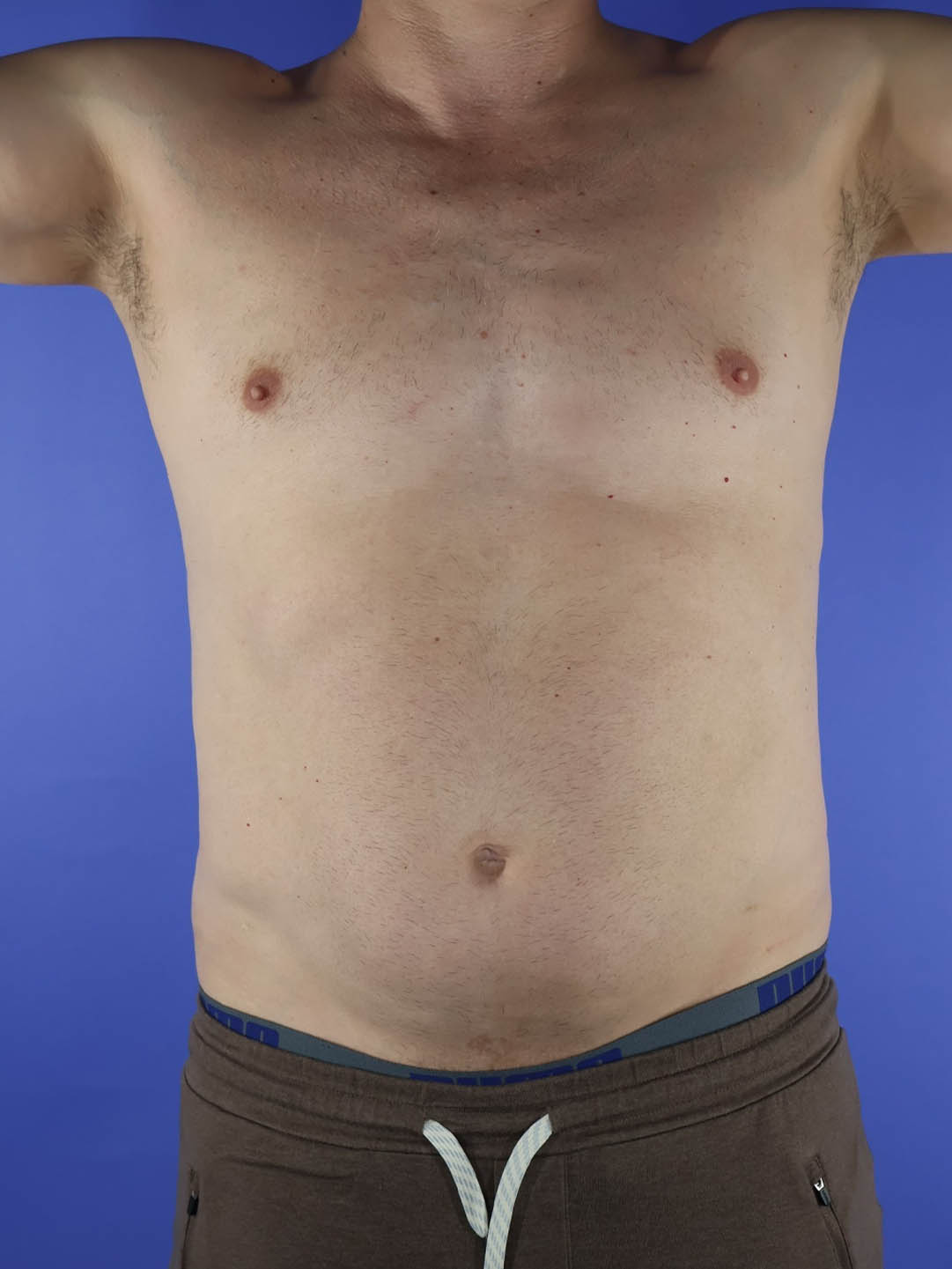 Gynecomastia real patient case photo Gynecomastia real patient case photo