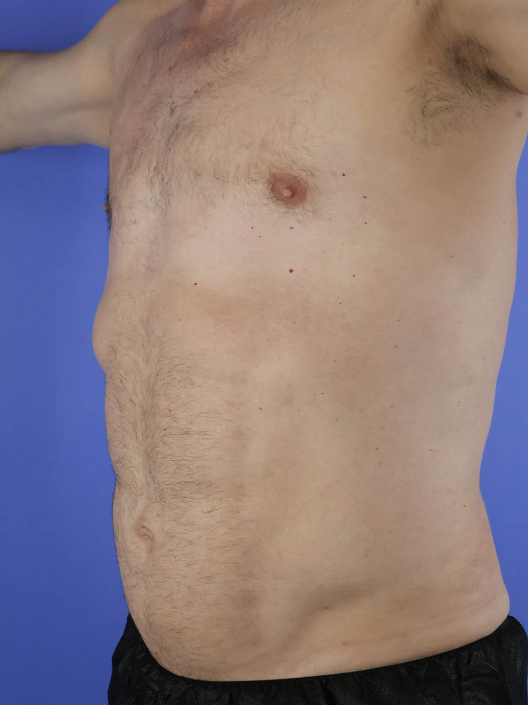 Gynecomastia real patient case photo Gynecomastia real patient case photo