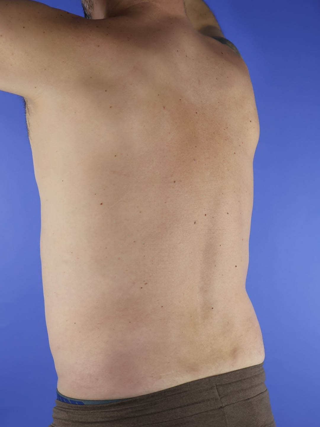 Gynecomastia real patient case photo Gynecomastia real patient case photo