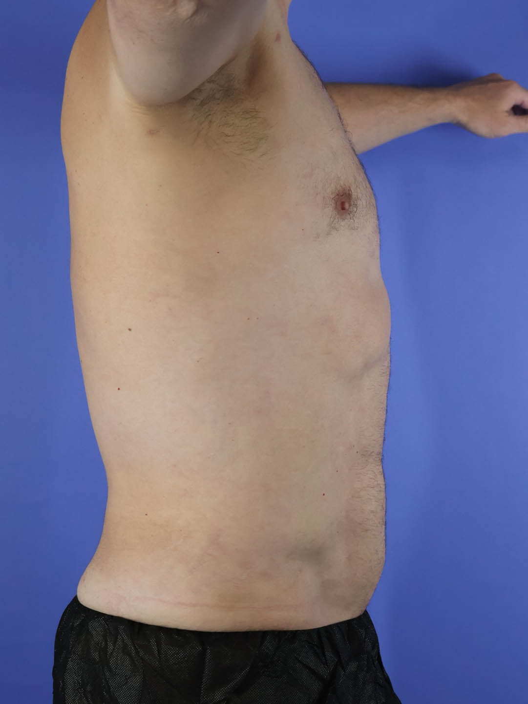 Gynecomastia real patient case photo Gynecomastia real patient case photo