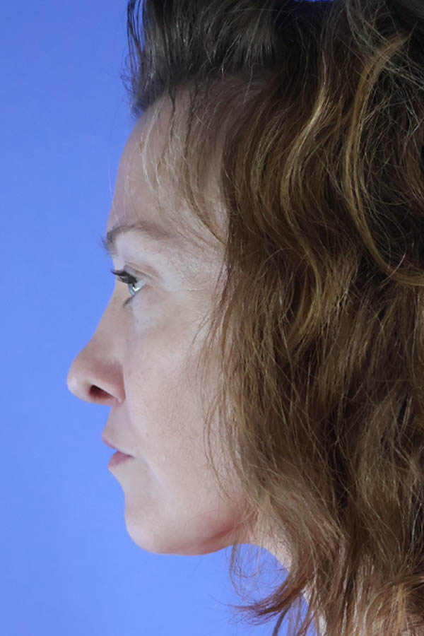 Lip Lift real patient case photo Lip Lift real patient case photo