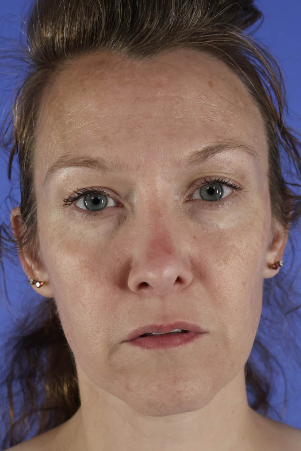 Lip Lift real patient case photo Lip Lift real patient case photo