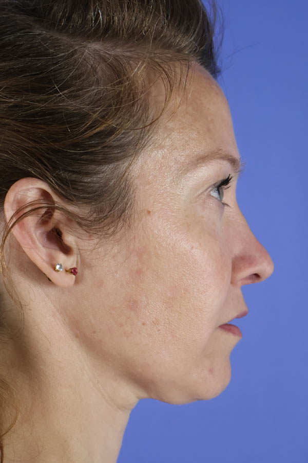 Lip Lift real patient case photo Lip Lift real patient case photo