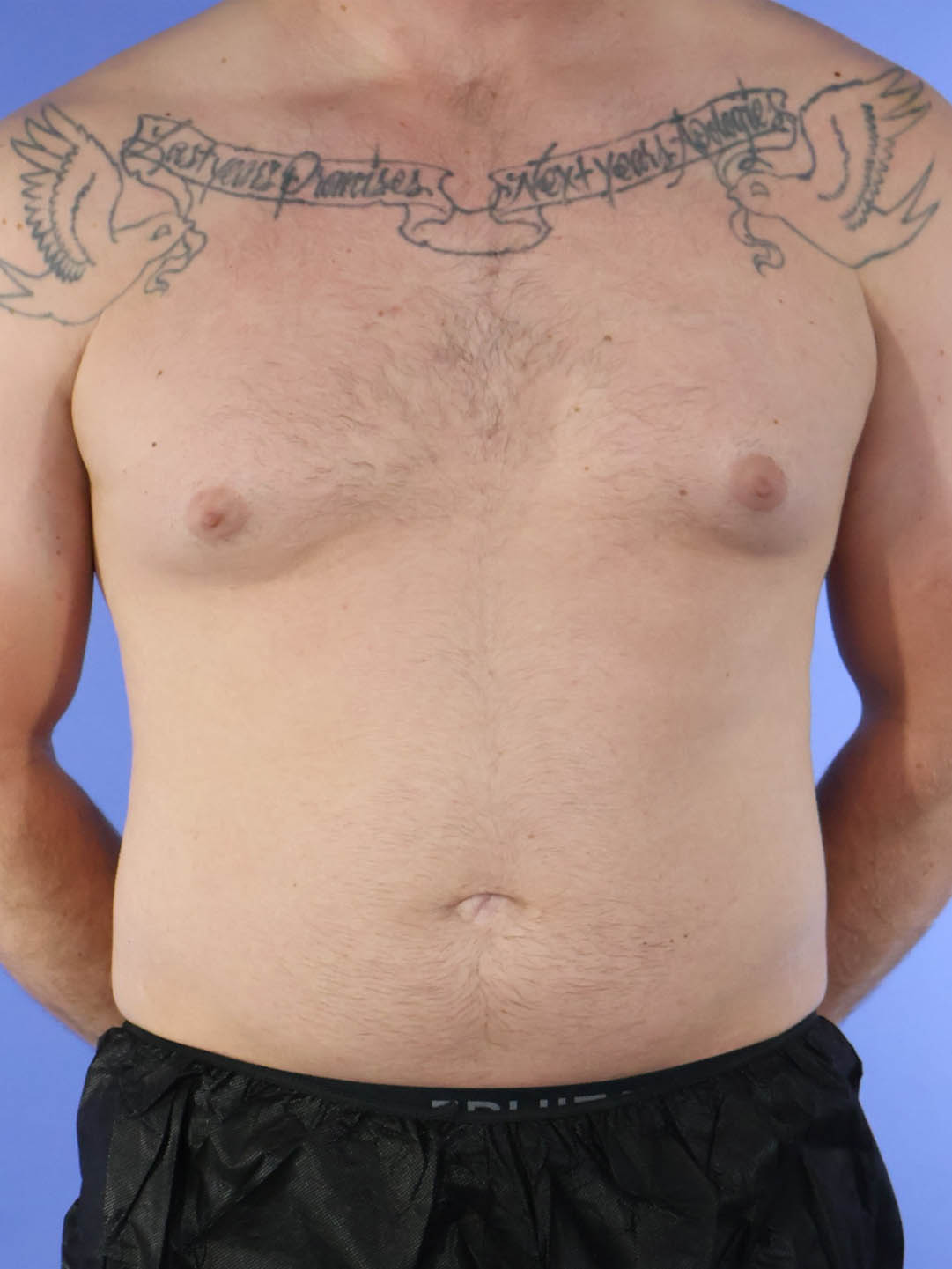 Gynecomastia real patient case photo Gynecomastia real patient case photo