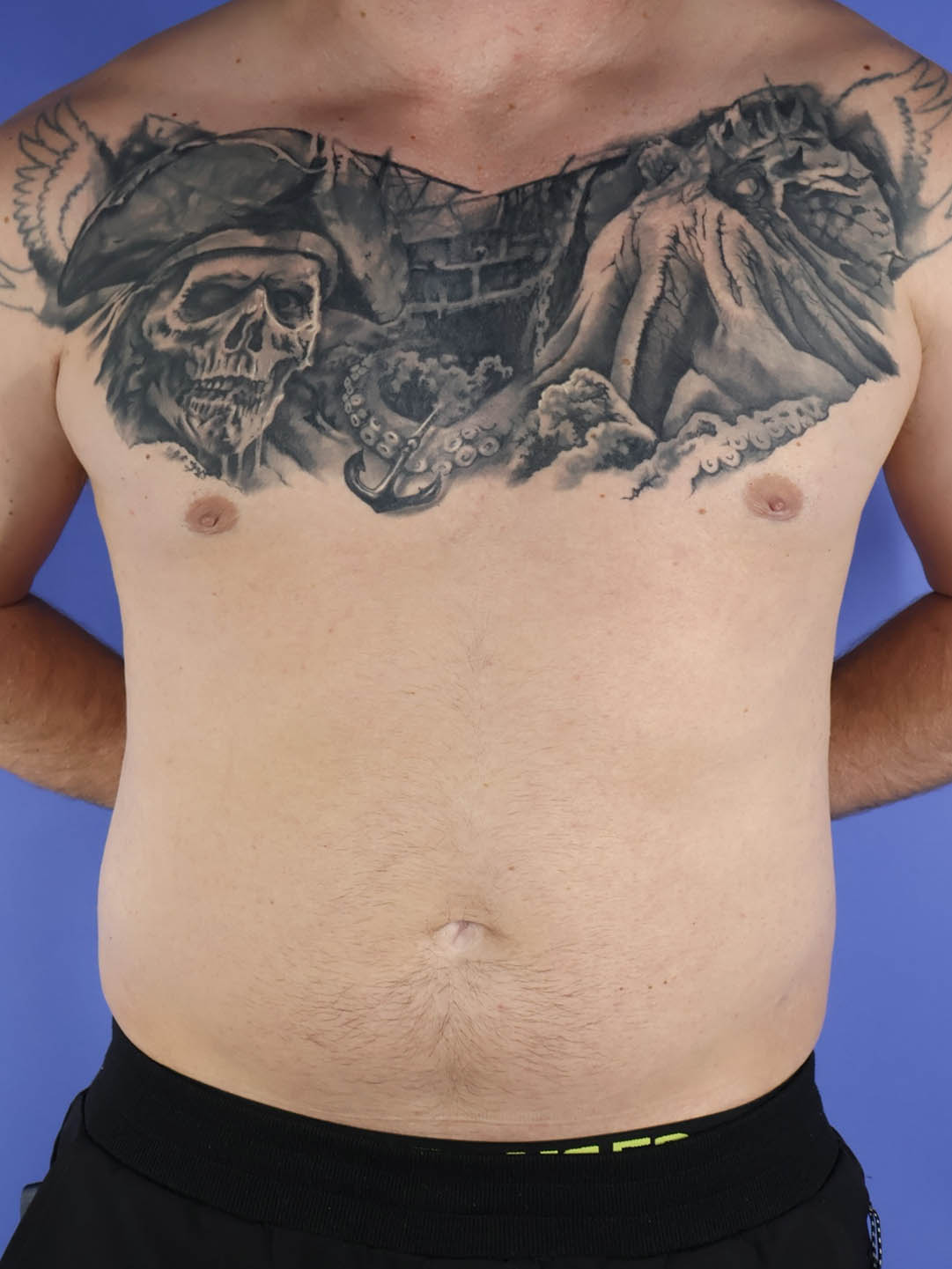 Gynecomastia real patient case photo Gynecomastia real patient case photo