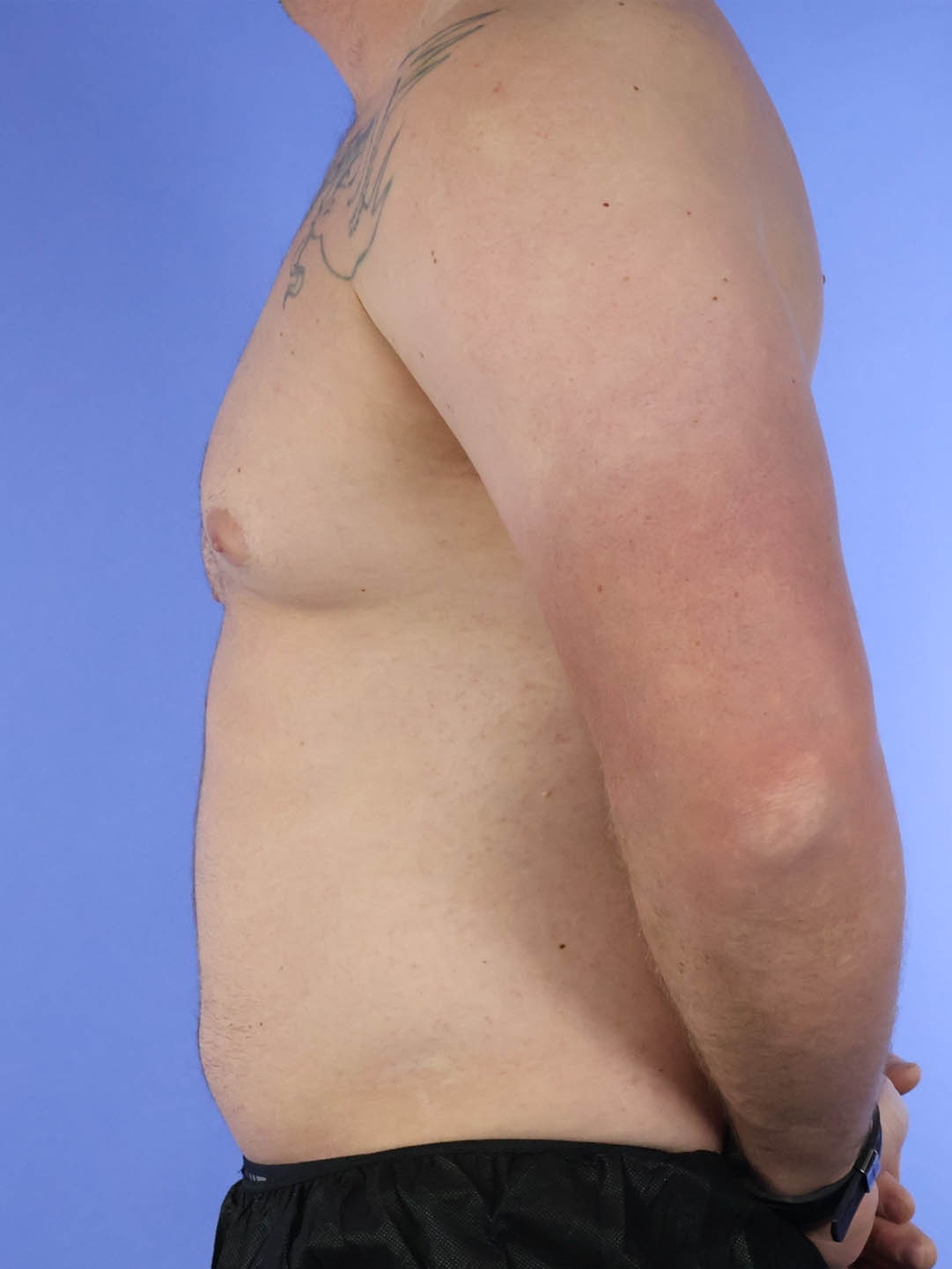 Gynecomastia real patient case photo Gynecomastia real patient case photo