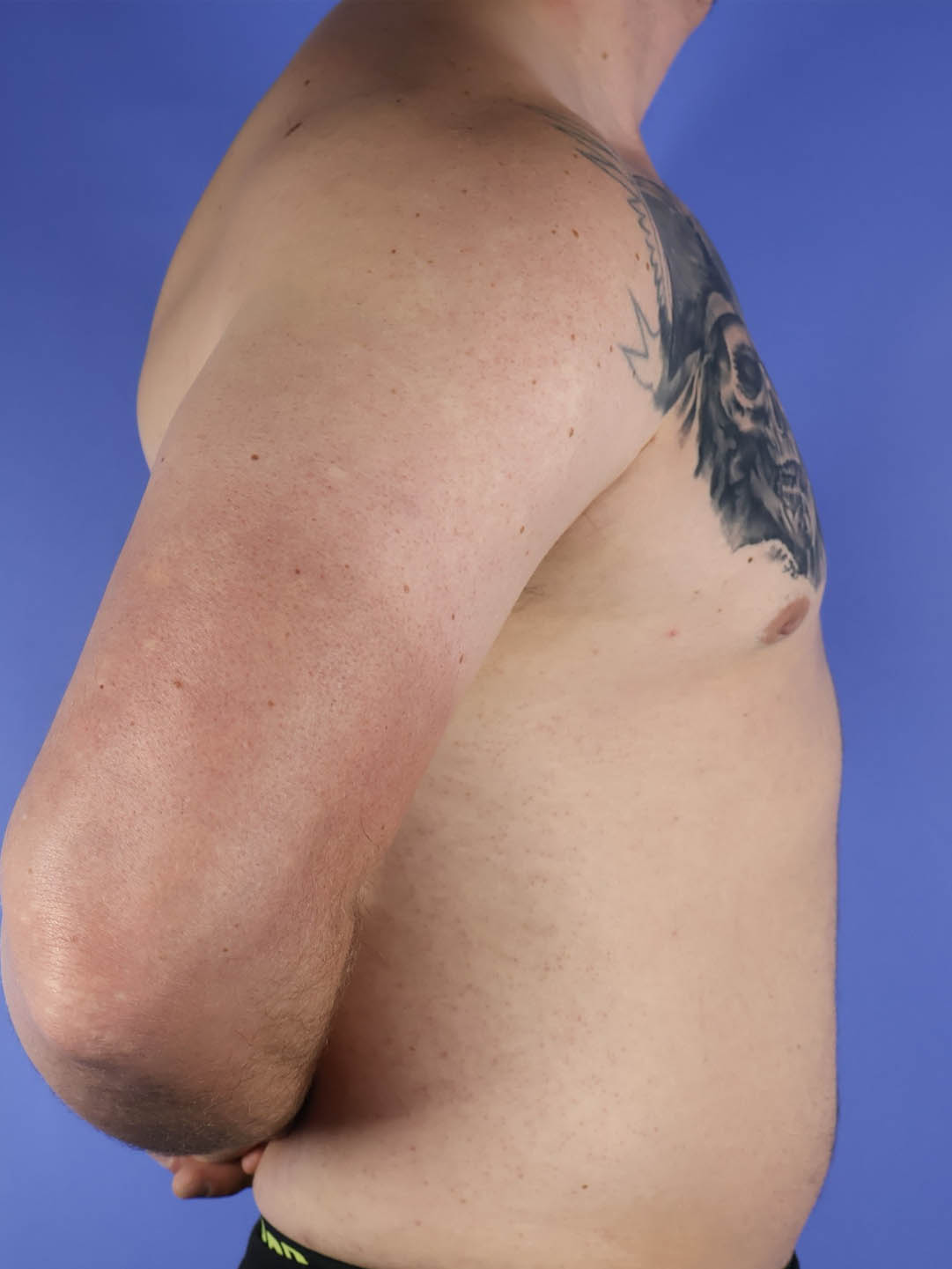 Gynecomastia real patient case photo Gynecomastia real patient case photo