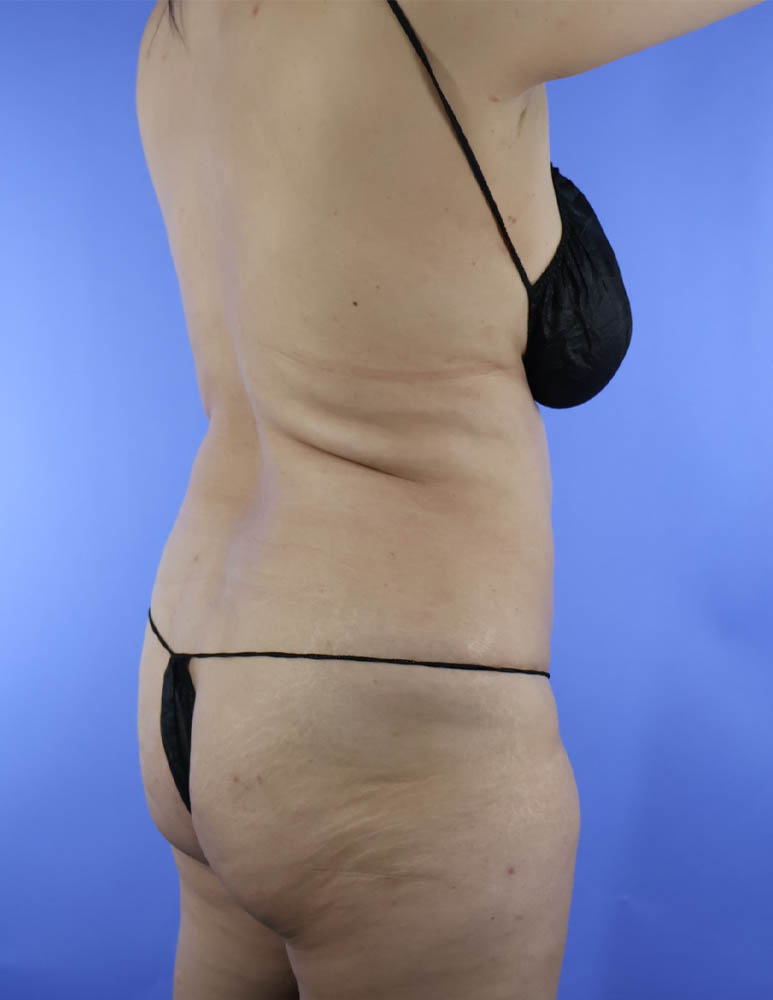 Brazilian Butt Lift real patient case photo Brazilian Butt Lift real patient case photo