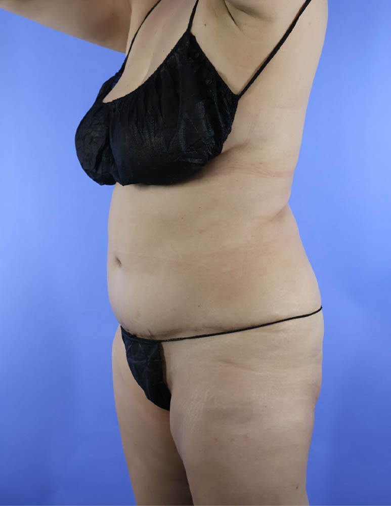 Brazilian Butt Lift real patient case photo Brazilian Butt Lift real patient case photo