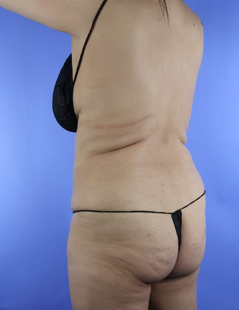 Brazilian Butt Lift real patient case photo Brazilian Butt Lift real patient case photo