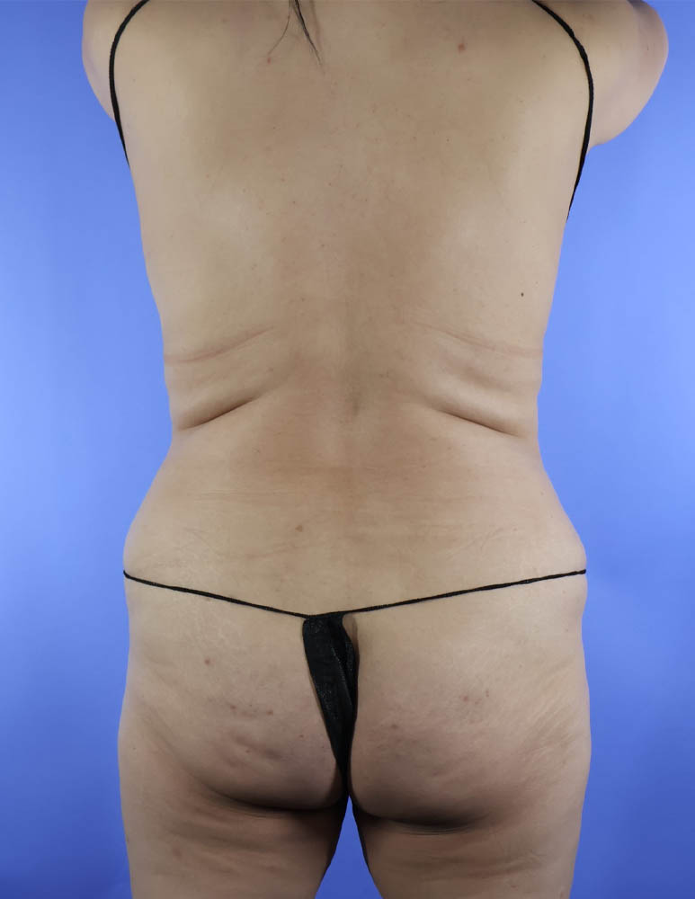 Brazilian Butt Lift real patient case photo Brazilian Butt Lift real patient case photo