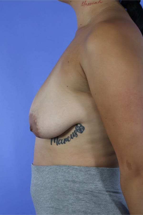 Breast Augmentation + Lift real patient case photo Breast Augmentation + Lift real patient case photo