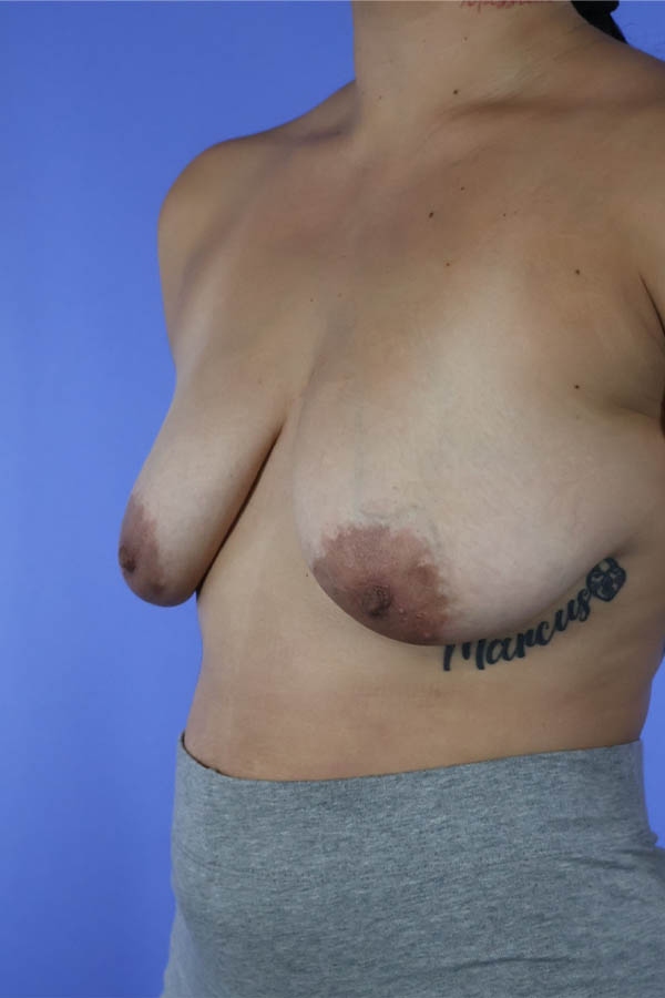 Breast Augmentation + Lift real patient case photo Breast Augmentation + Lift real patient case photo