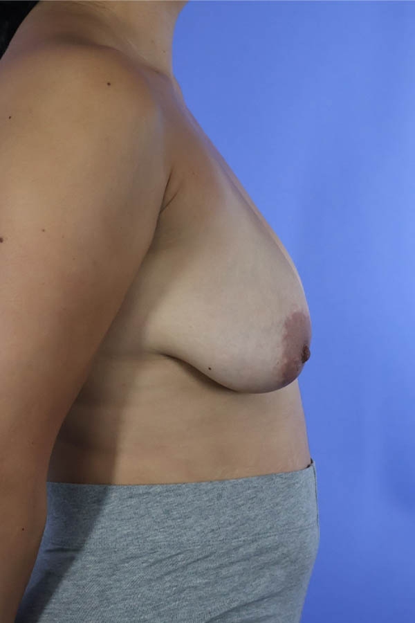 Breast Augmentation + Lift real patient case photo Breast Augmentation + Lift real patient case photo