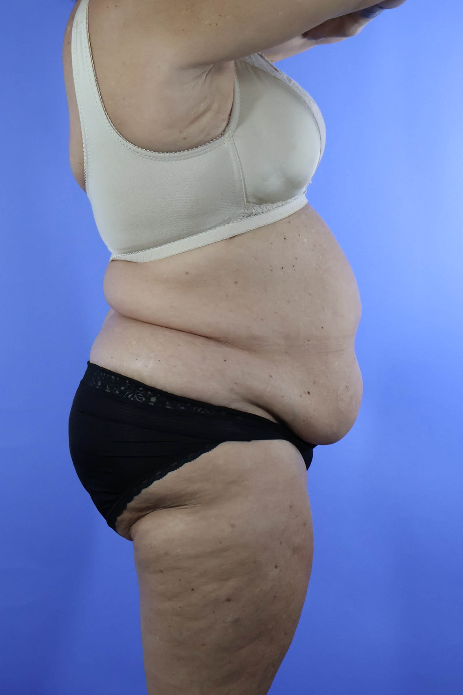 Tummy Tuck real patient case photo