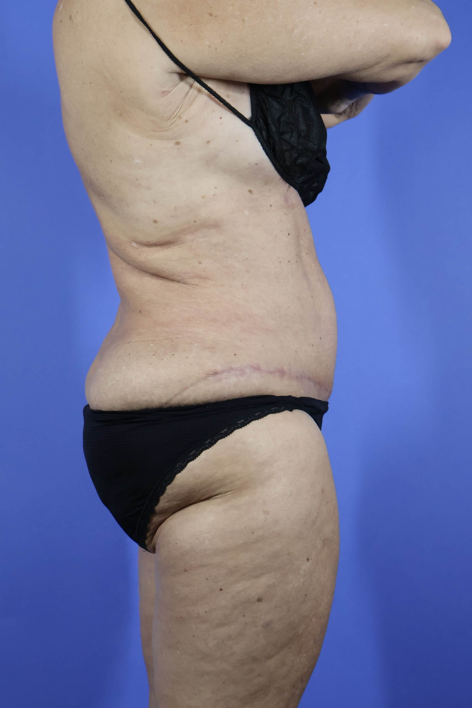 Tummy Tuck real patient case photo