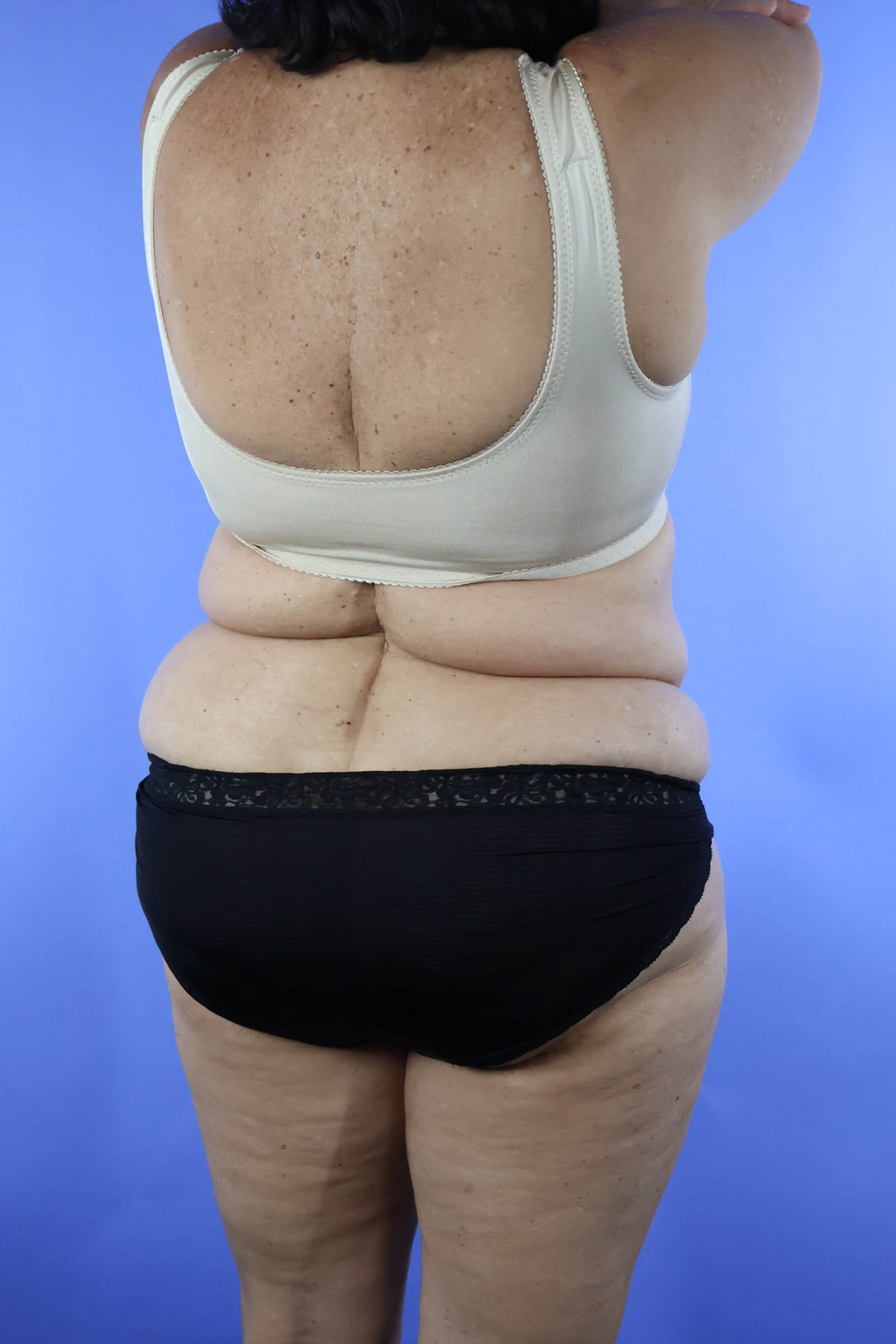 Tummy Tuck real patient case photo