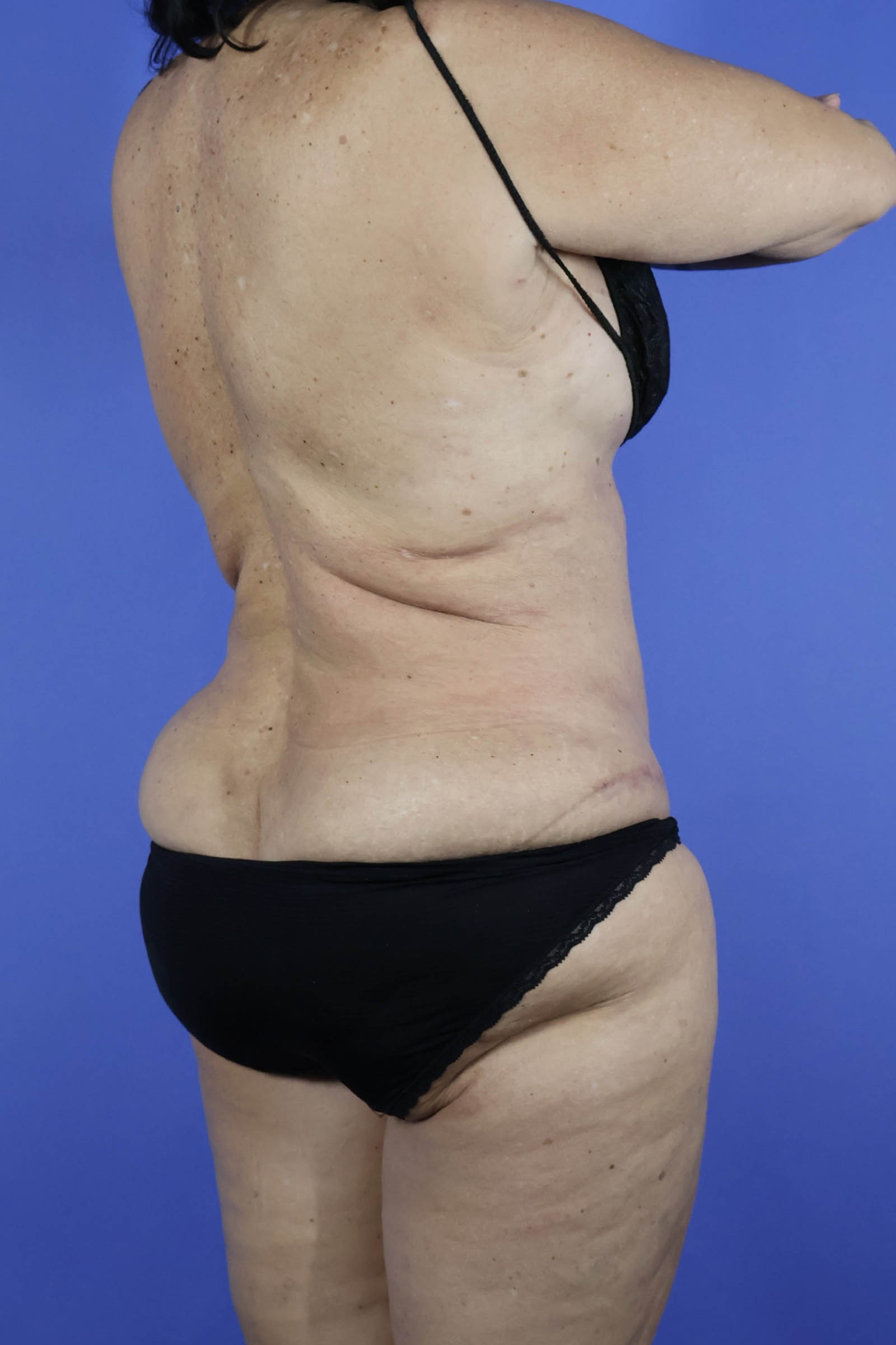 Tummy Tuck real patient case photo