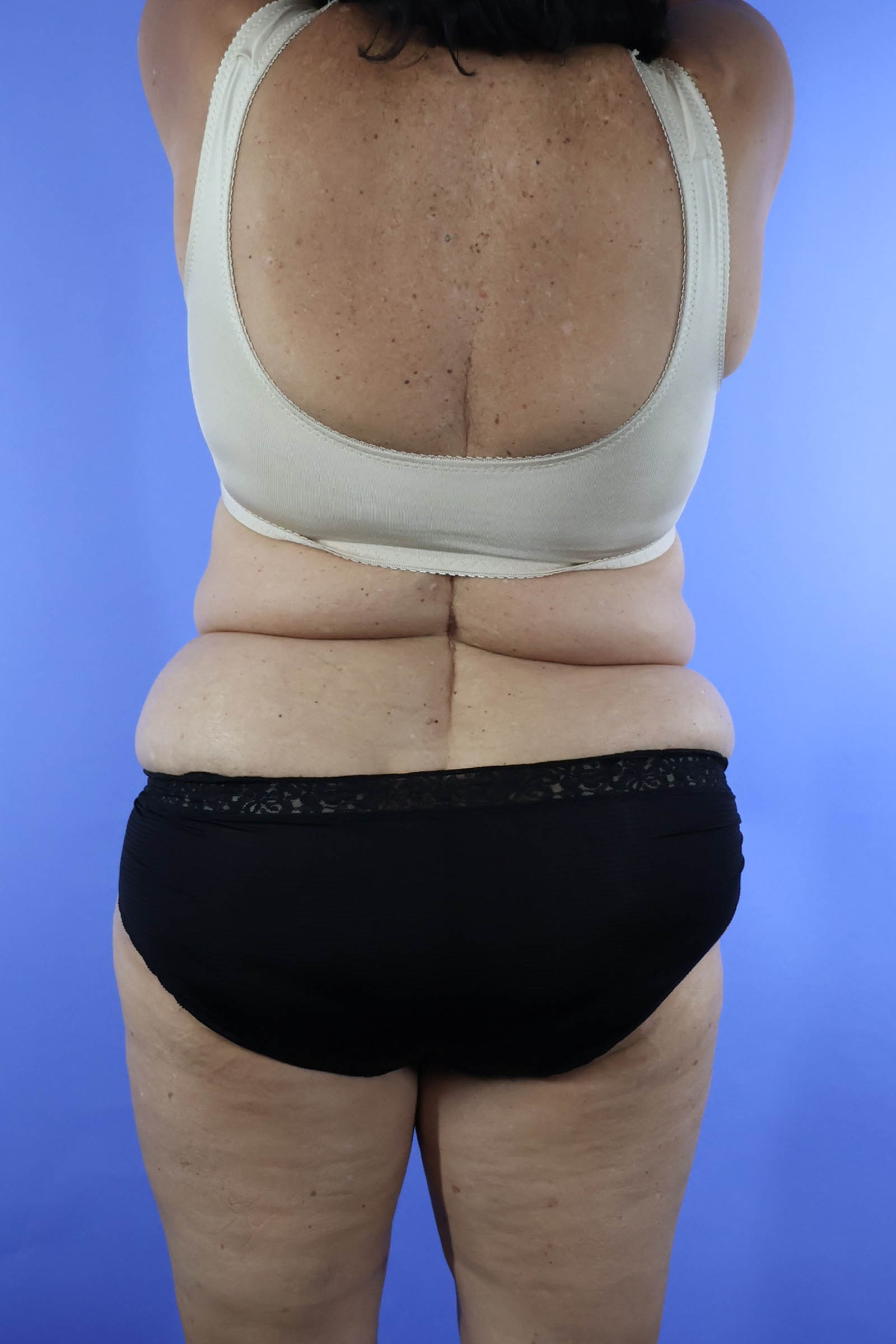 Tummy Tuck real patient case photo