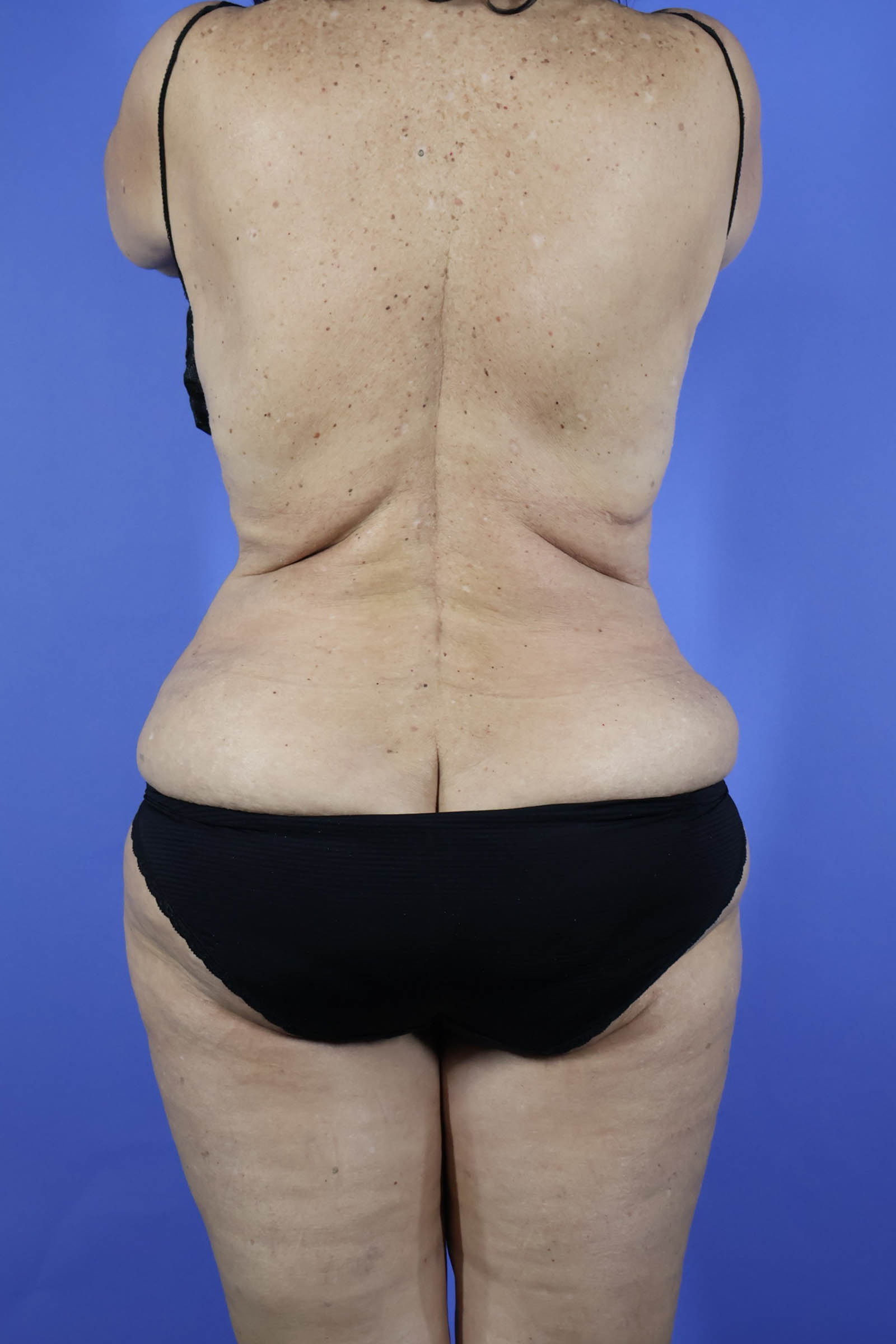 Tummy Tuck real patient case photo