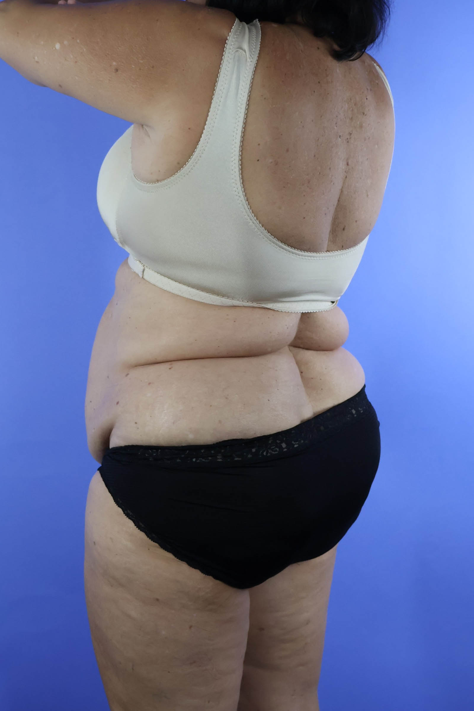 Tummy Tuck real patient case photo