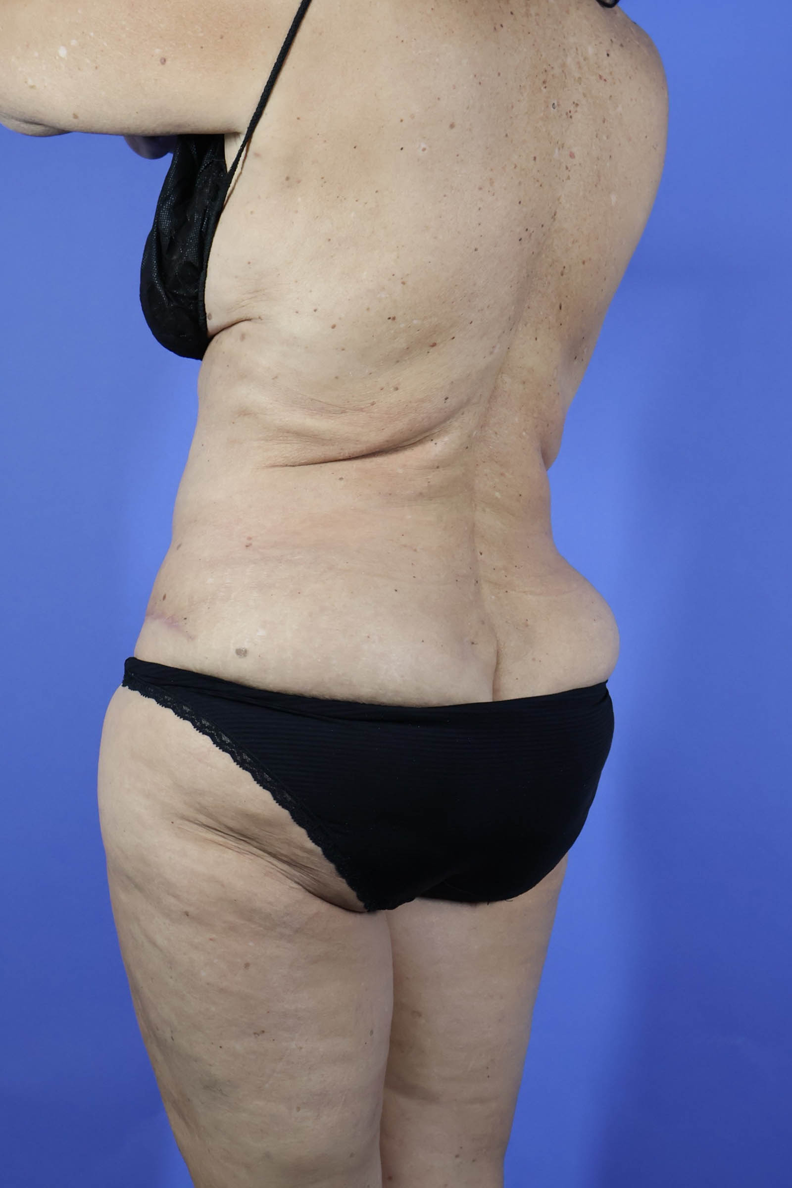 Tummy Tuck real patient case photo