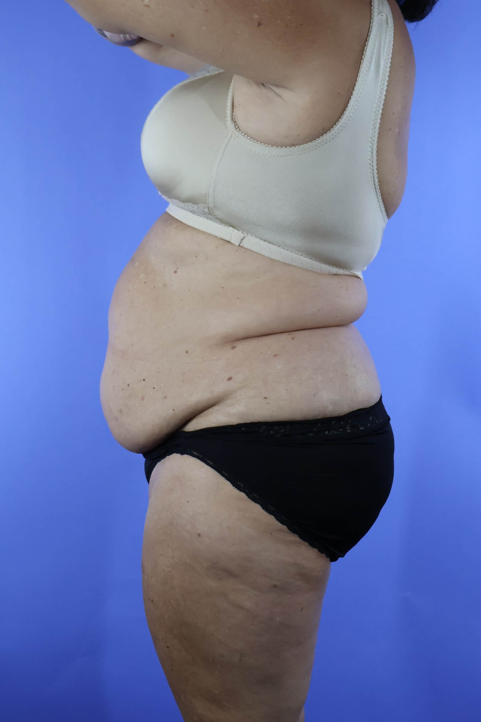 Tummy Tuck real patient case photo