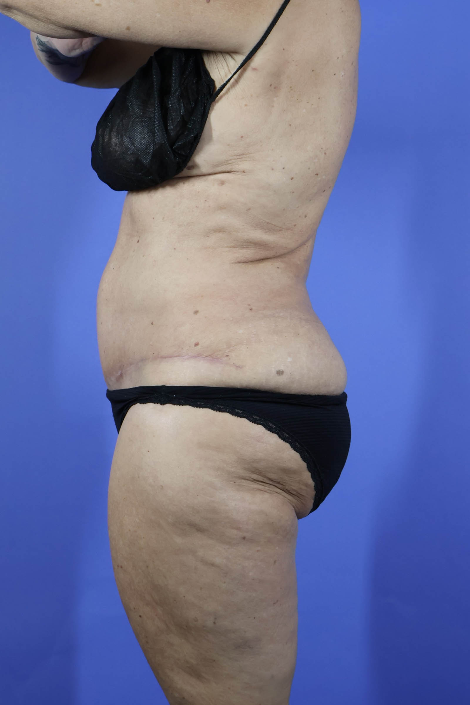 Tummy Tuck real patient case photo
